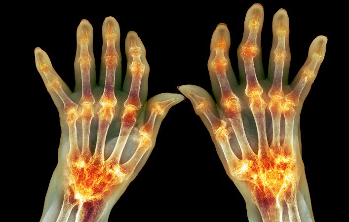 rheumatoid_arthritis.jpg