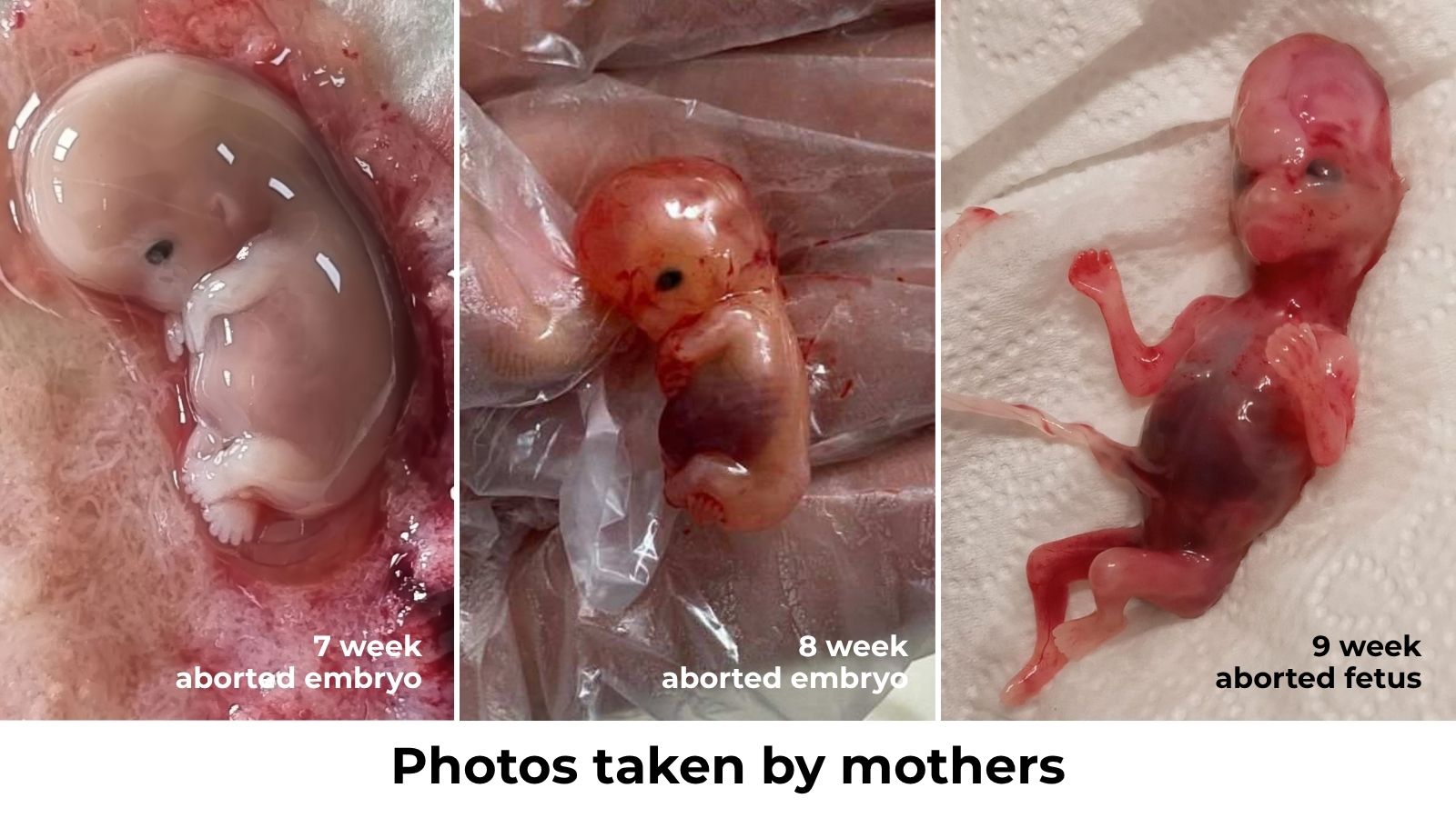 Pills by post aborted babies