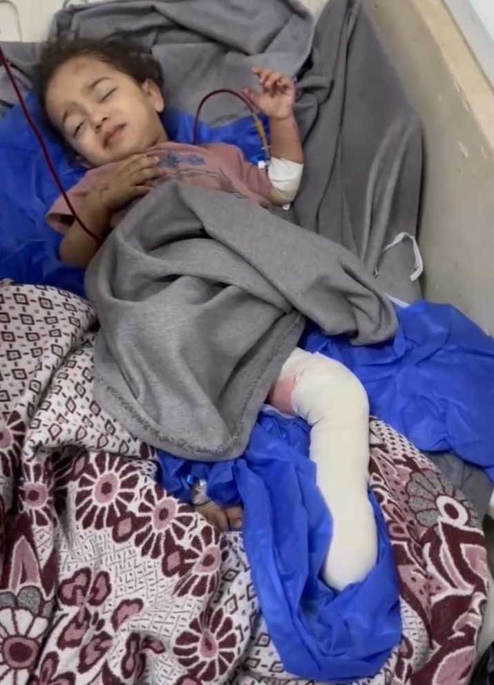 Two-year-old Misk after amputating her left foot. (Photo: Courtesy of the Duqqi family)