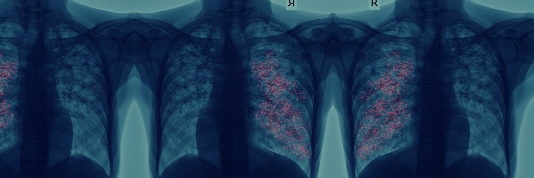 Watch the video: Ending Neglect of Tuberculosis 