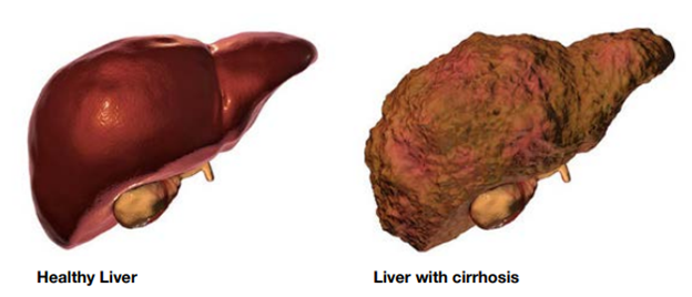 Liver with and without cirrhosis