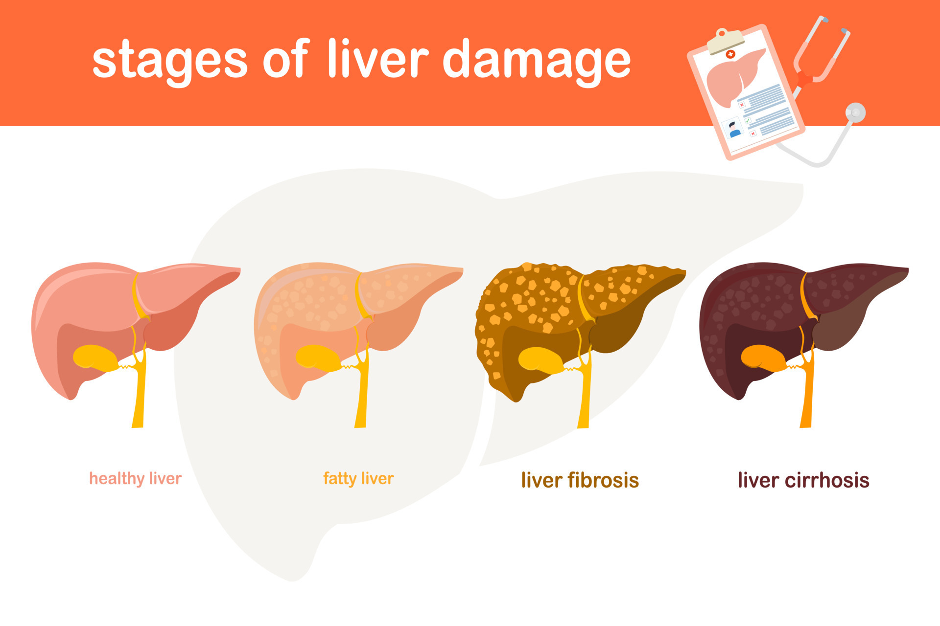 stage-illustration-of-liver-damage-from-healthy-liver-to-fatty-liver-liver-fibrosis-to-cirrhosis-flat-design-healthy-concept-vector.jpg