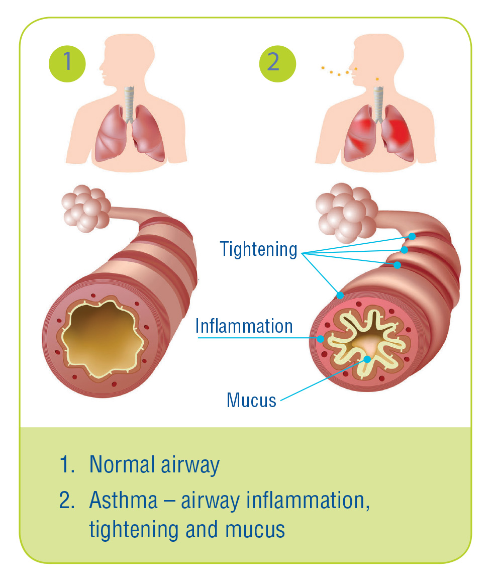 difference between Normal Airway and asthma airway 